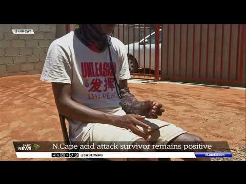 N. Cape acid attack survivor remains positive