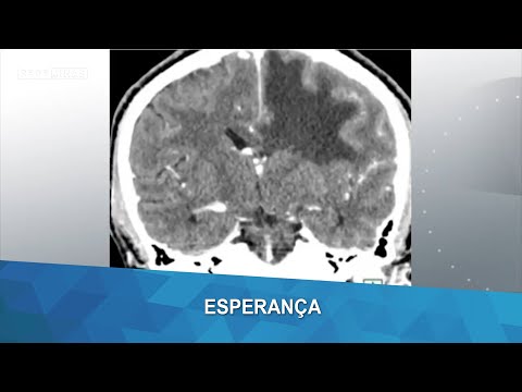 Esperança: Vírus da Zika é testado contra tumor no cérebro