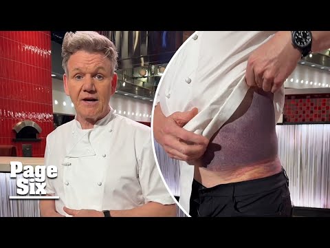 Gordon Ramsay, 57, shows off gruesome injuries after scary bike accident: ‘Lucky to be here’