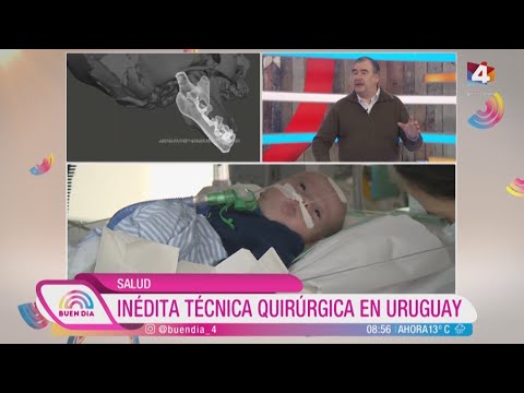 Buen Día - Inédita técnica quirúrgica en Uruguay