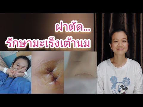 สงสัยจัง|มะเร็งเต้านม(ตั้งแ