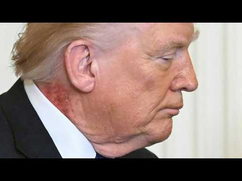 Ausschlag an Trumps Hals sorgt für neue Spekulationen