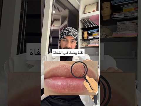 نقط بيضاء في الشفايف ✅
