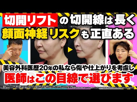 【切開リフト徹底解説2024 中編】傷あとがキレイ＆顔面神経損傷を避けるための医師選びポイントは？【リフトアップ整形は簡単な手術ではありません】美容外科歴20年ベテラン名医の本音