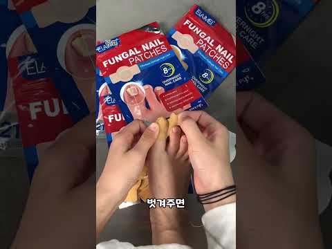 발톱무좀 붙혀서 해결