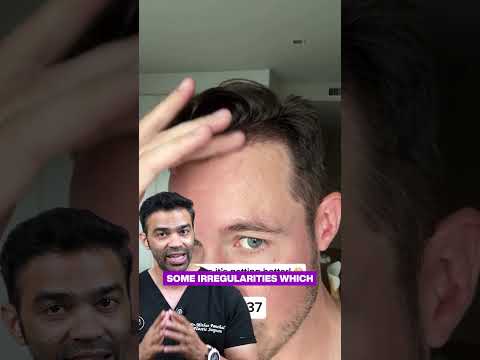 The Secret Behind Natural Hair Transplants: Zig-Zag Hairline Technique | FUE Design Tips