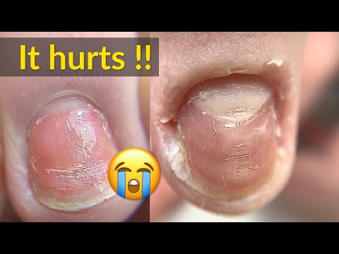 Badly Damaged Nails Transformation with Acrylic
