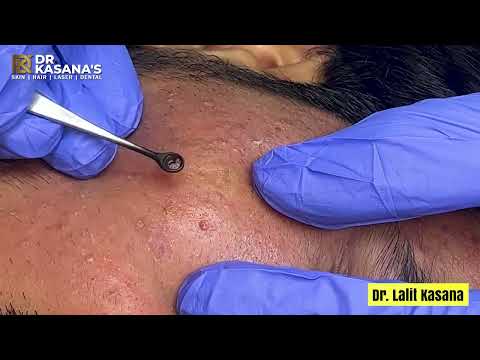 Blackheads Removal Treatment with Comedone Extractor tool By Dr Lalit Kasana #blackheads