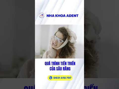 Tiến triển sâu răng - Nha Khoa ADENT