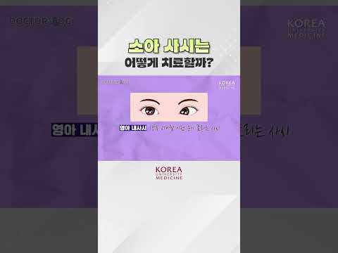 소아 사시 수술, 언제 하면 좋을까?