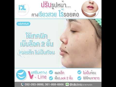 IDLReview:เสริมคาง𝑽-𝑳𝒊𝒏𝒆คา