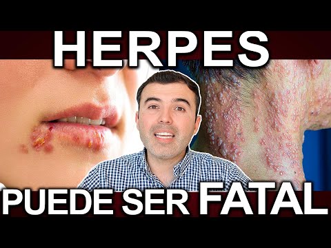 COMO CURAR EL HERPES - Elimina El Virus Del Herpes Para Siempre 100% Efectivo