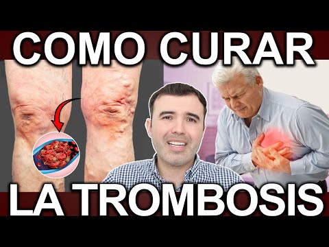 COMO CURAR LOS TROMBOS O TROMBOSIS 2025 - Diluye Los Trombos O Cuagulos Y Evita Infartos