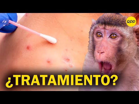 ¿Hay tratamiento para la viruela del mono? ¿Necesitamos vacunarnos?