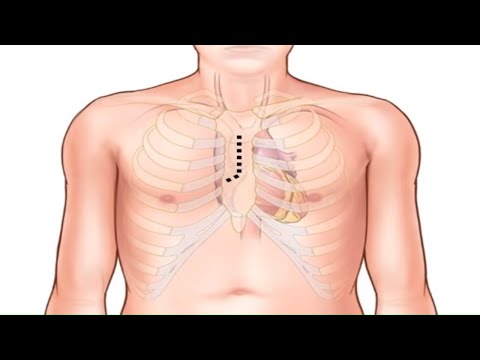 Aortic Valve Replacement with a Pericardial Tissue Valve