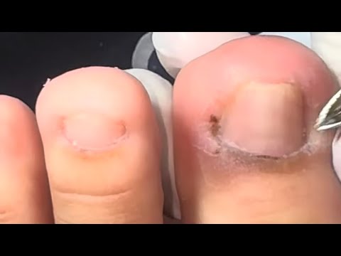 Ep_7270Footnailsskinremova