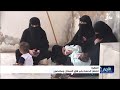 انتشار الحصبة في المهرة يثير قلق السكان والمختصون