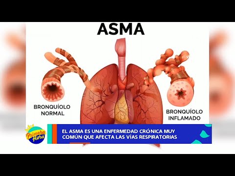 Asma bronquial causas y consecuencias