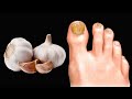 Beseitigt Nagelpilz sofort. Das beste Mittel gegen Pilze und Parasiten. Vorteile von Knoblauch.