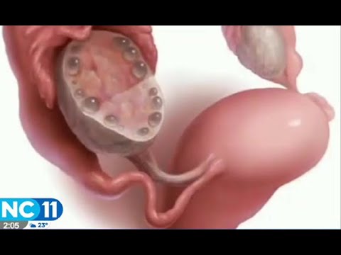 Causas y síntomas del síndrome de ovario poliquístico
