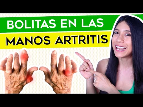 Bolitas en dedos y manos: Nódulos de Artritis y Artrosis