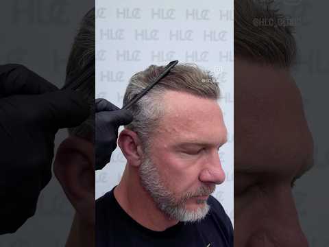 hairline restoration with 3524 Grafts by HLC, before, post op, 12 months results.  #hairstyle