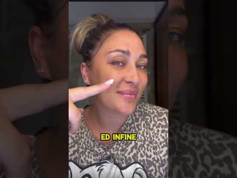 Acne: risultati prima e dopo Lara