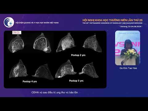 3. CĐHA vú sau điều trị ung thư vú bảo tồn (GS. Kim Tae Hee)