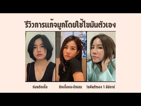 แก้จมูกโดยใช้ไขมันตัวเองbyคุ