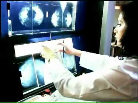 What is Molecular Breast Imaging (MBI)? Physician's Prospective :
Early detection of Breast Cancer