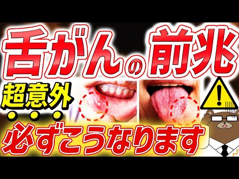 【堀ちえみさんも】口内炎が前兆?知らないと後悔する「舌がん」の初期症状。意外な兆候と見分け方とは。「歯」が舌がんの原因？〇〇が好きな人はリスク大。舌の大半を失う？正しい予防法とは。医師が徹底解説！