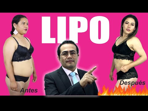 LIPO  RESULTADO Impresionante  Lipoescultura de INFARTO  Dr PERCY NEVADO ? Cirugía Plástica