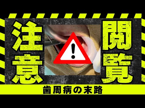 グロ注意！歯周病でボロボロになった歯をぶっこ抜く