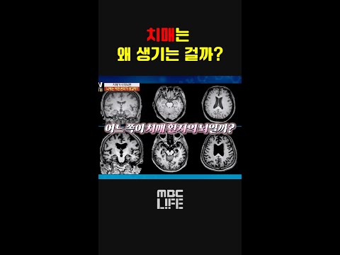 치매가 시작되면 뇌에는 <strong>어떤</strong> 변화가 생길까? #MBCLIFE