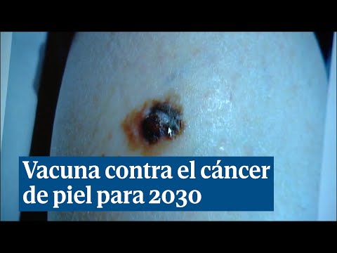 Moderna anuncia una vacuna contra el cáncer de piel para 2030