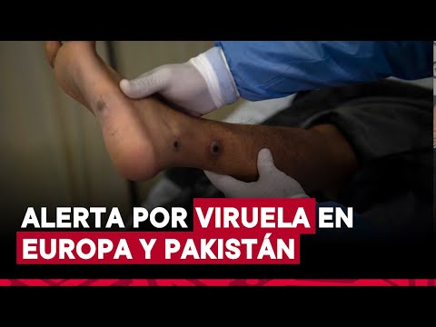 Pakistan reporta primer caso de viruela del mono