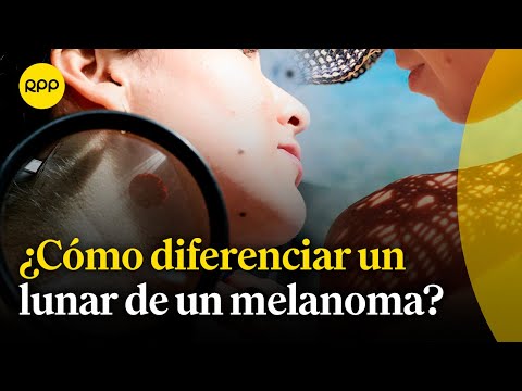 Día del lunar: ¿Cómo diferenciar un lunar de un melanoma? | Salud