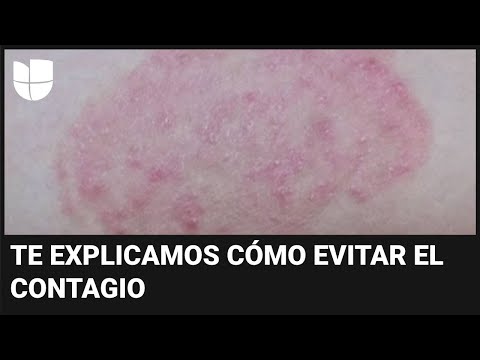 Alertan de un hongo muy contagioso presente en gimnasios: el Dr. Juan explica cómo protegerte