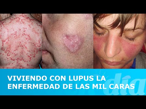 Viviendo con lupus la enfermedad de las mil caras