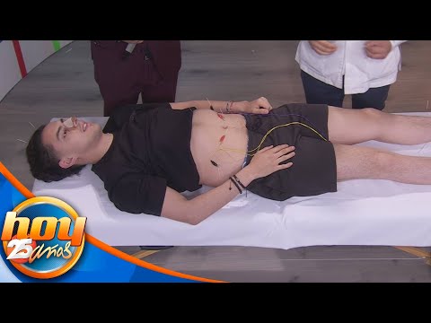 Baja de peso con el poder de la acupuntura: conoce sus beneficios en el cuerpo | Programa Hoy