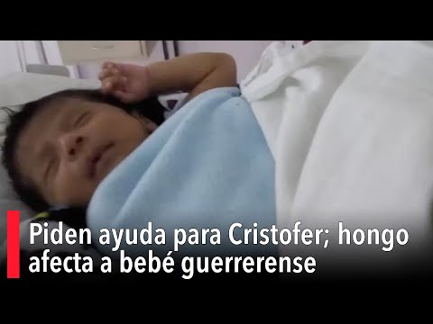 Piden ayuda para Cristofer; hongo afecta a bebe? guerrerense