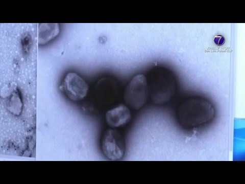 Confirman nuevo caso de viruela símica en SLP