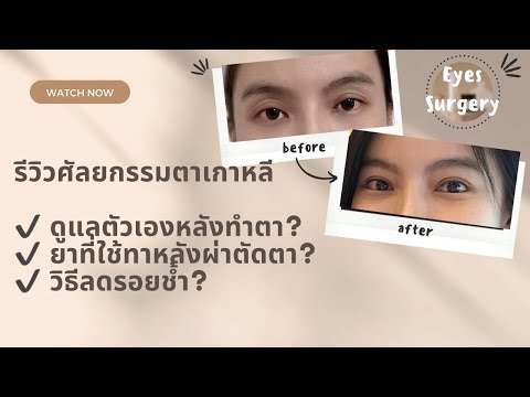 รีวิวศัลยกรรมตาเกาหลีมัดกล้าม