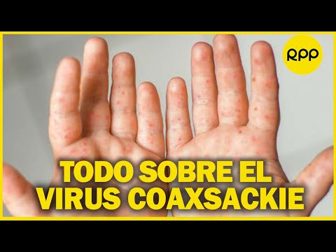 ¿Qué es el virus Coxsackie y cómo se contagia?