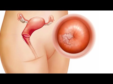 Lesiones intraepiteliales cervicales durante el embarazo - Dra. Norma Ozal Mora