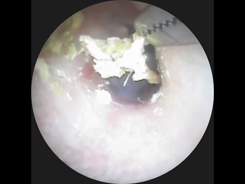Vol.311【耳掃除】耳の奥に潜む「何か」の正体とは・・eariss