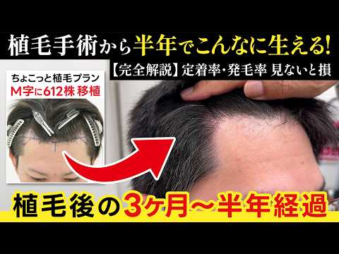 【M字改善】植毛半年でこんなに生える!【3ヶ月→6ヶ月の発毛経過とダウンタイム】【ちょこっと植毛プラン・612グラフトの植毛結果】