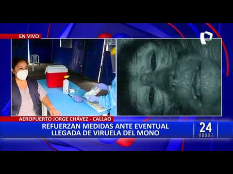 Viruela del Mono: refuerzan medidas de diagnóstico en Aeropuerto Jorge Chávez