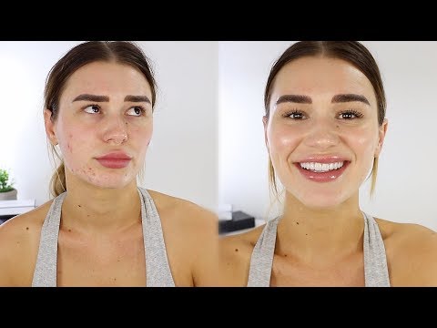 5 MIN EVERYDAY MAKEUP TUTORIAL // HIDING MY ACNE