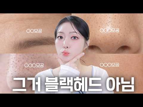 블랙헤드인 줄 알았던 모공의 정체!🗯️ 모공 종류 4가지와 관리법